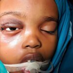 Pakistani hospital saves Somali girl from life-threatening eye tumor.